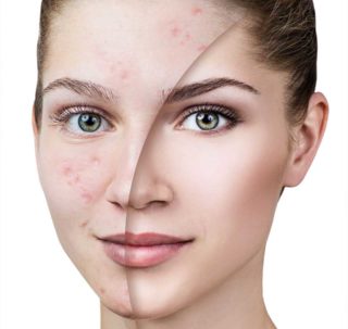 condition-images-acne-1